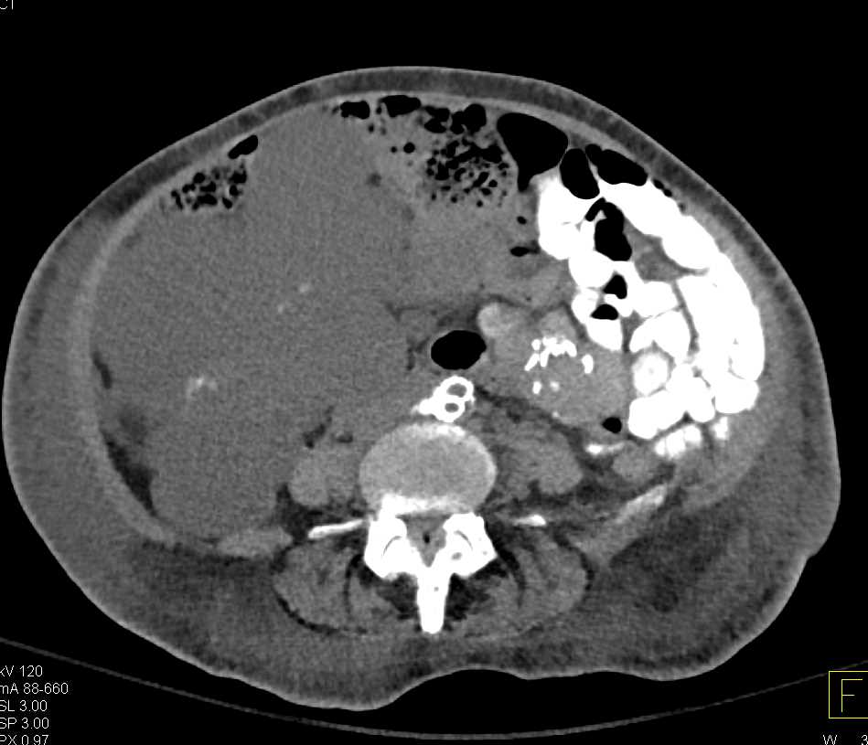 Pseudomyxoma Peritonei (PMP) - CTisus CT Scan