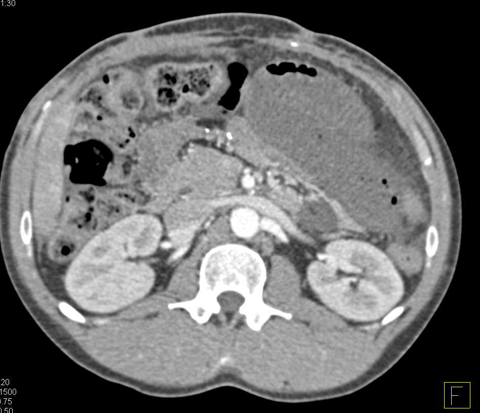 Pseudomyxoma Peritonei (PMP) - CTisus CT Scan