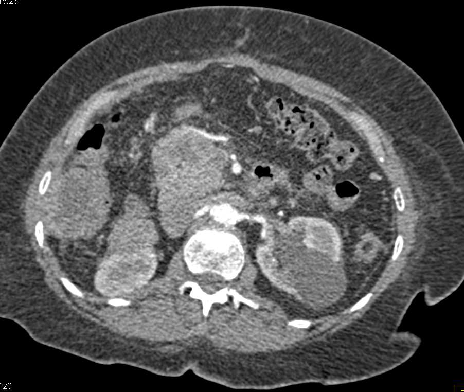 Metastatic Melanoma with Multiple Masses - CTisus CT Scan
