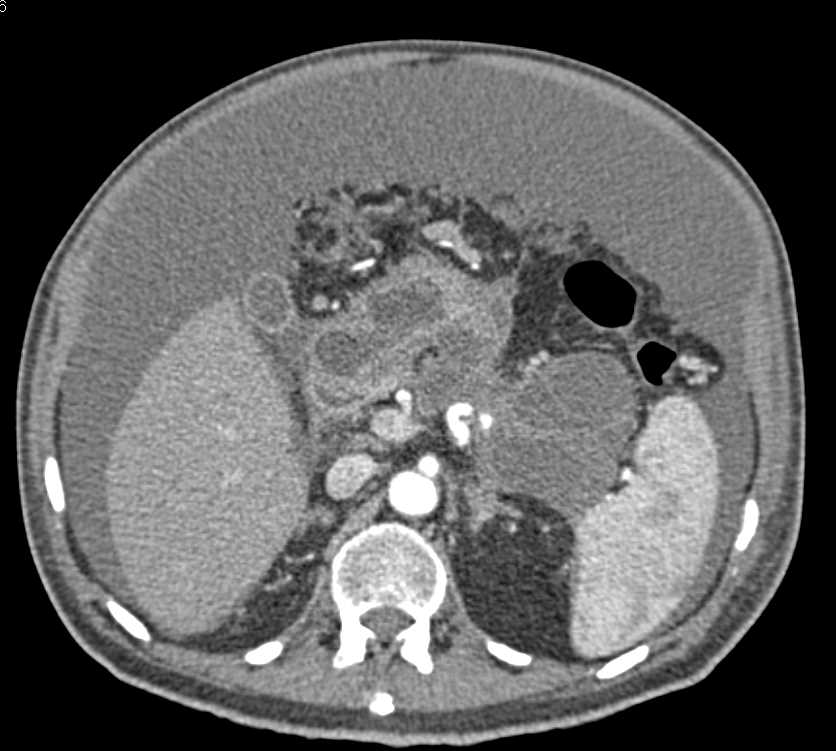 Carcinomatosis with Pseudomyxoma Peritonei - CTisus CT Scan