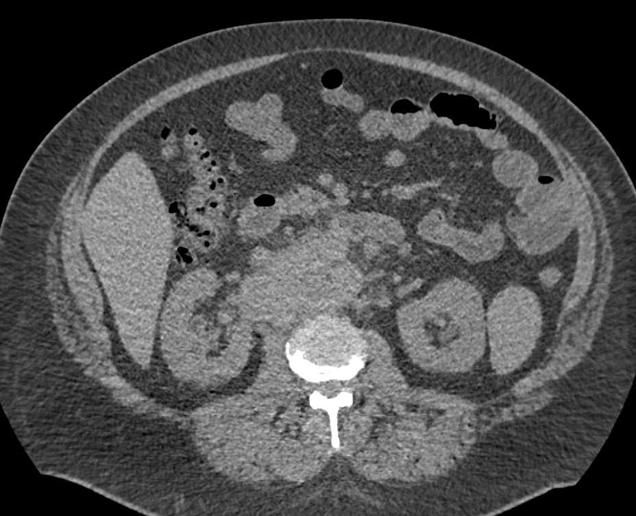 Lymphoma with Extensive Adenopathy - CTisus CT Scan