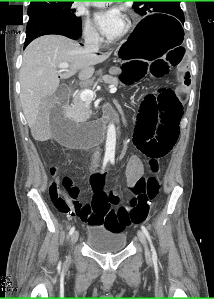 Pneumoperitoneum due to Bowel Perforation - CTisus CT Scan