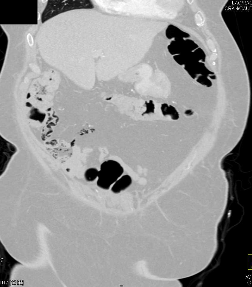 G-Tube is Dislocated into the Abdominal Wall - CTisus CT Scan