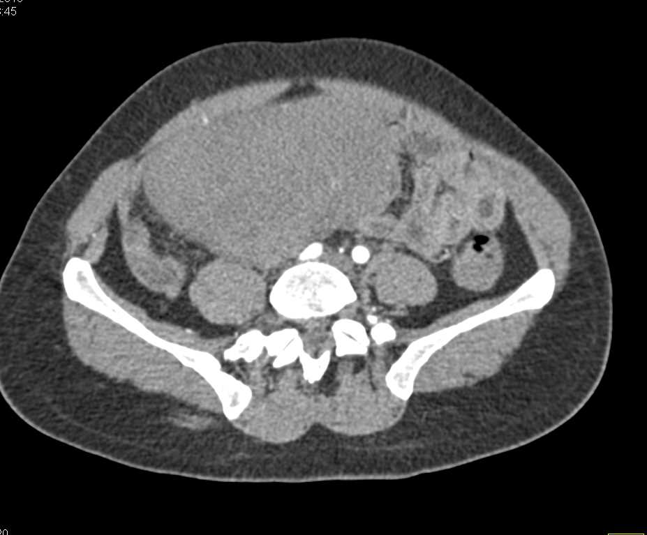 Desmoid Tumor - CTisus CT Scan