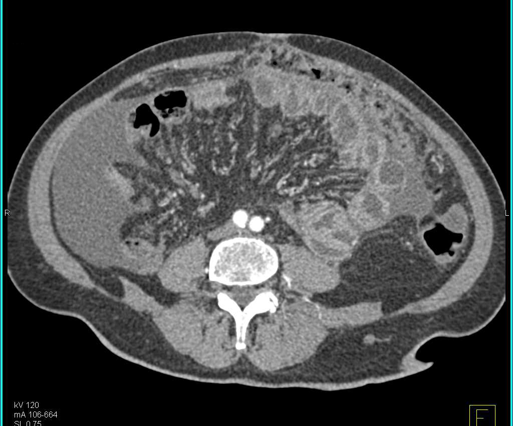 Carcinomatosis of the Abdomen - CTisus CT Scan