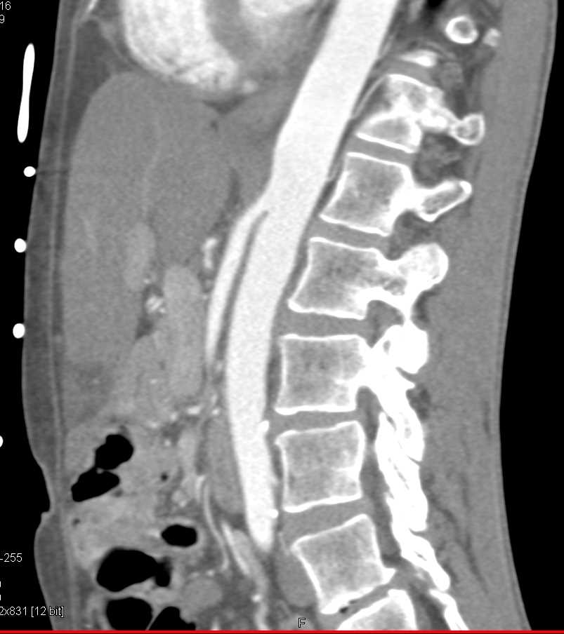 Superior Mesenteric Artery (SMA) Syndrome - CTisus CT Scan