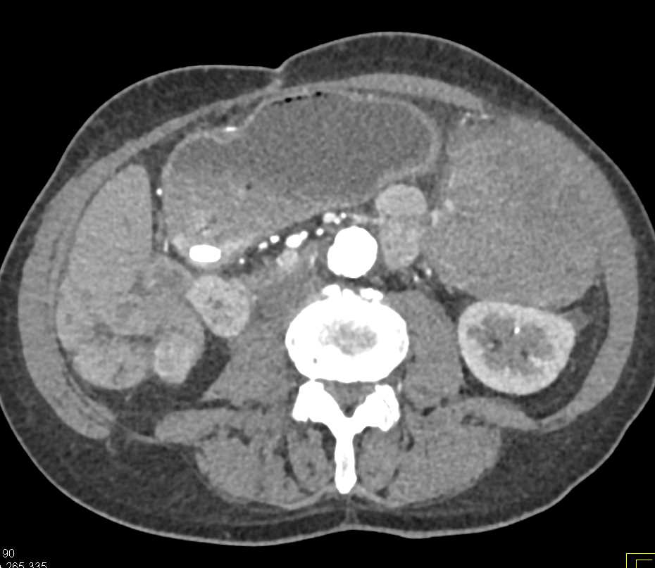 Recurrent GIST Tumor with Implants - CTisus CT Scan