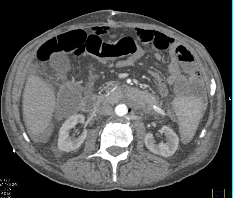 Active Bleed in the Rectum - CTisus CT Scan