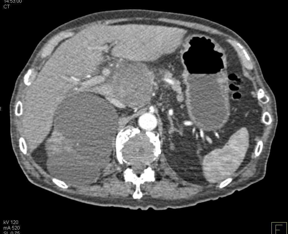 Adenopathy Simulating a Pancreatic Mass - CTisus CT Scan