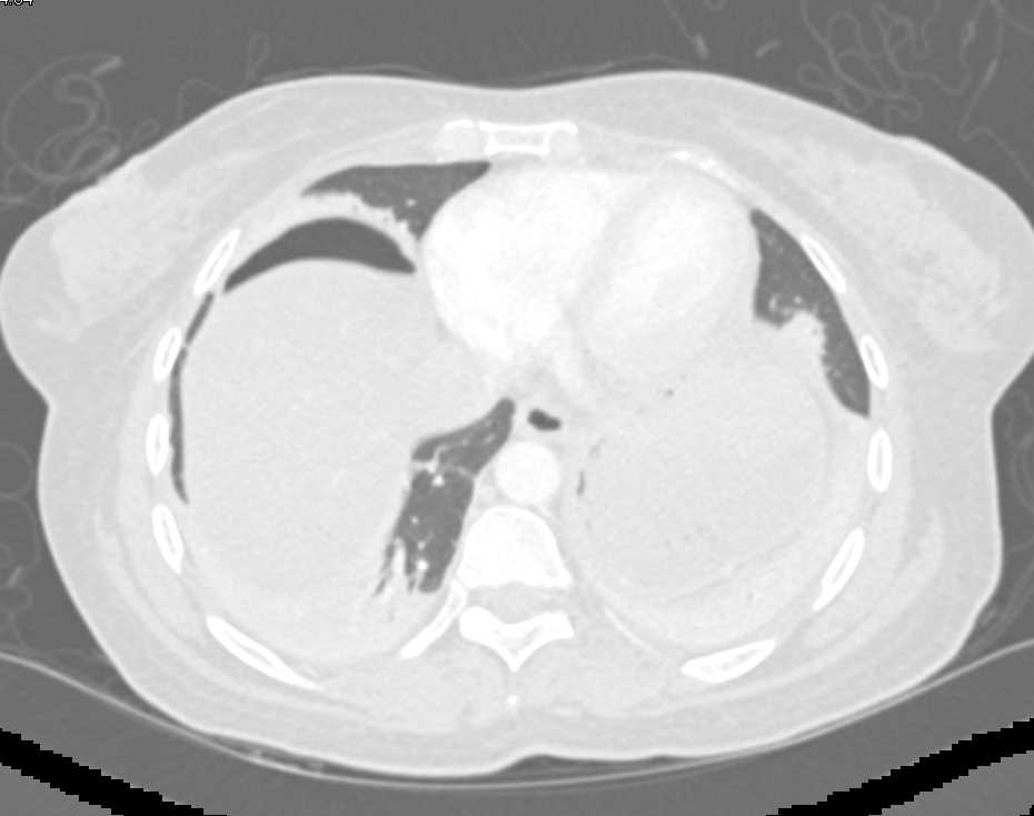 Pneumoperitoneum - CTisus CT Scan