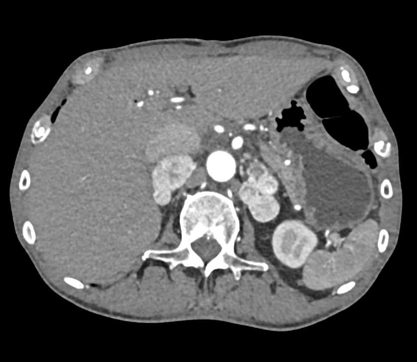 Metastatic Neuroendocrine Tumor - CTisus CT Scan