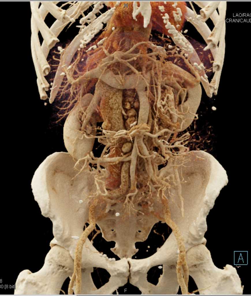 Metastatic Neuroendocrine Tumor with Cinematic Rendering - CTisus CT Scan