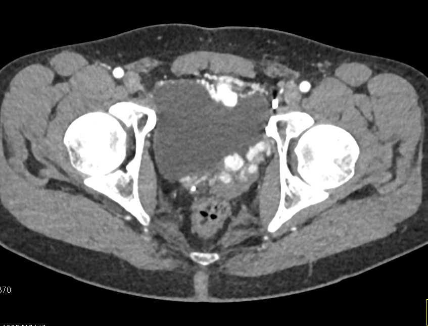 Carcinomatosis with Pelvic Implants - CTisus CT Scan