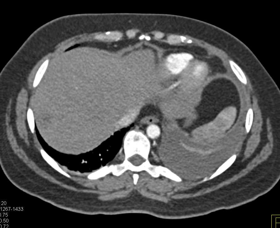 Lymphoma Infiltrates the Kidneys as well as the Liver and the Right Iliac Crest - CTisus CT Scan