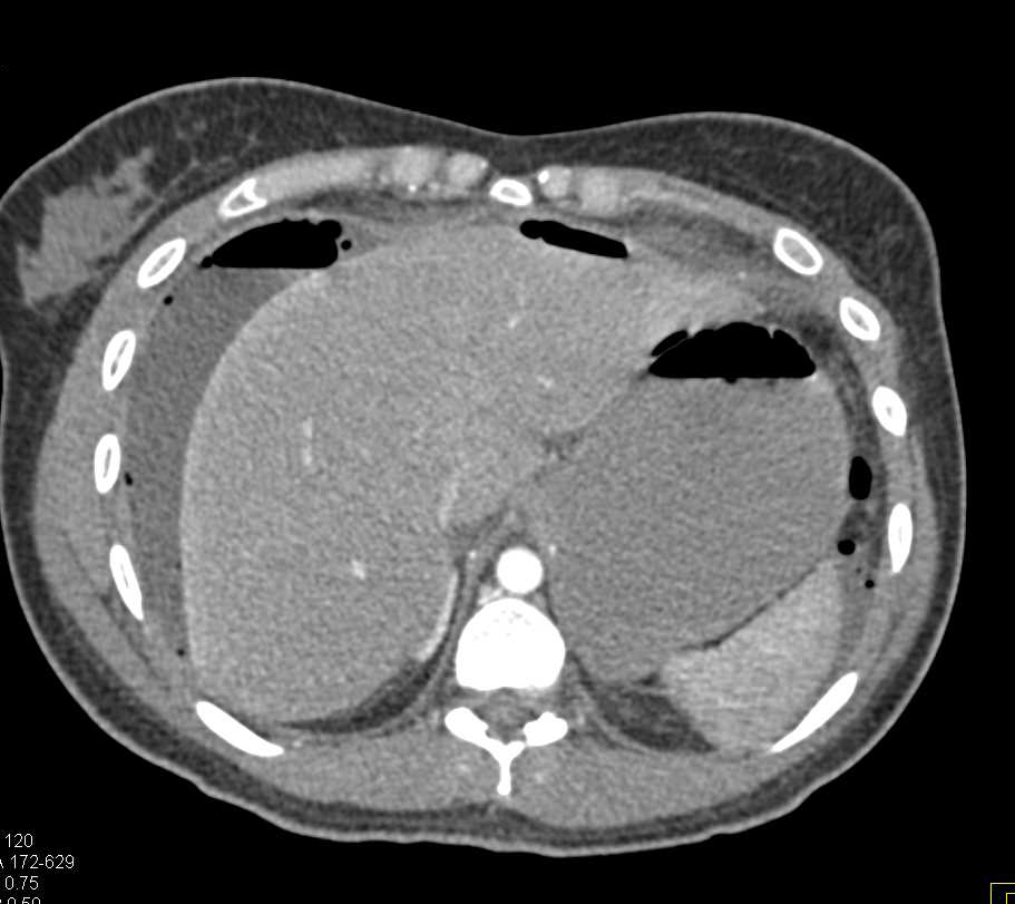 Pneumoperitoneum and Peritonitis due to Bowel Perforation - CTisus CT Scan