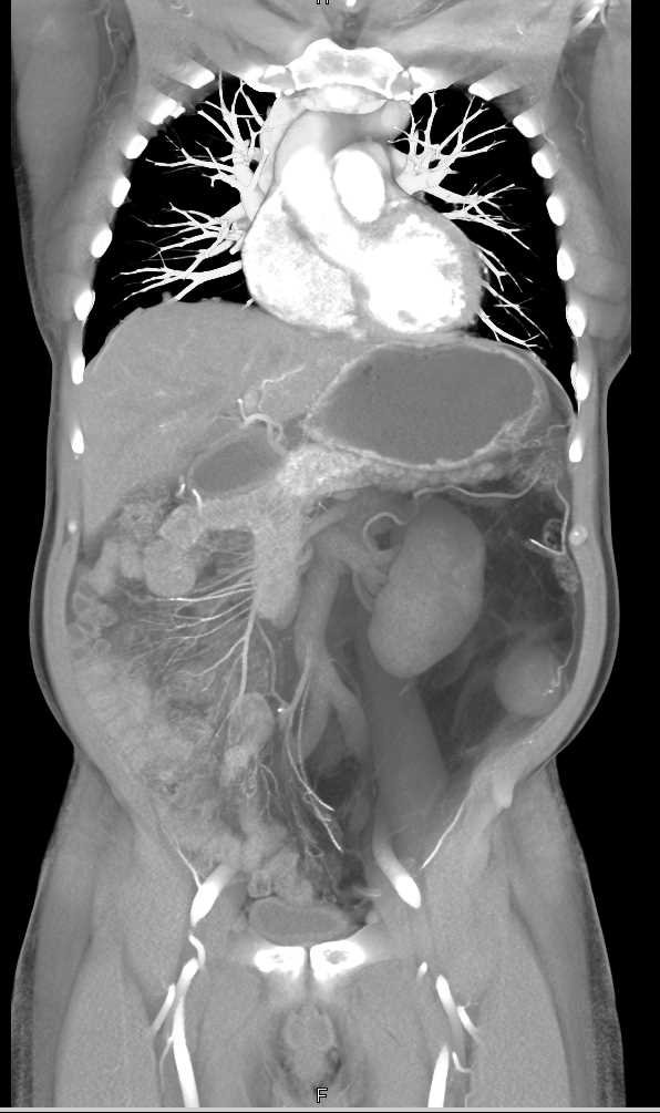 Retroperitoneal Liposarcoma - CTisus CT Scan