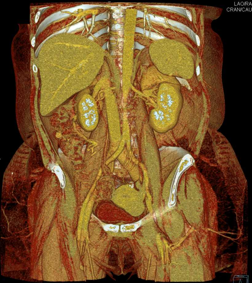 Cinematic Rendering of the Bowel and Mesentery - CTisus CT Scan