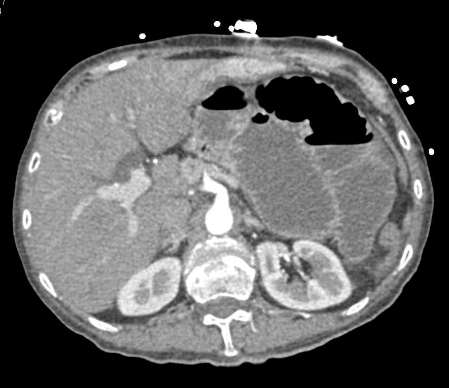 Carcinoma Cecum Obstructs the Small Bowel and Also Liver Metastases - CTisus CT Scan
