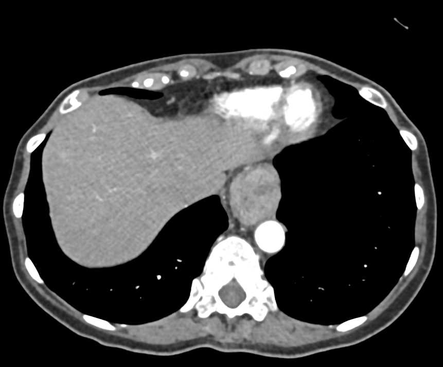 Esophageal and Pancreatic Cancer - CTisus CT Scan