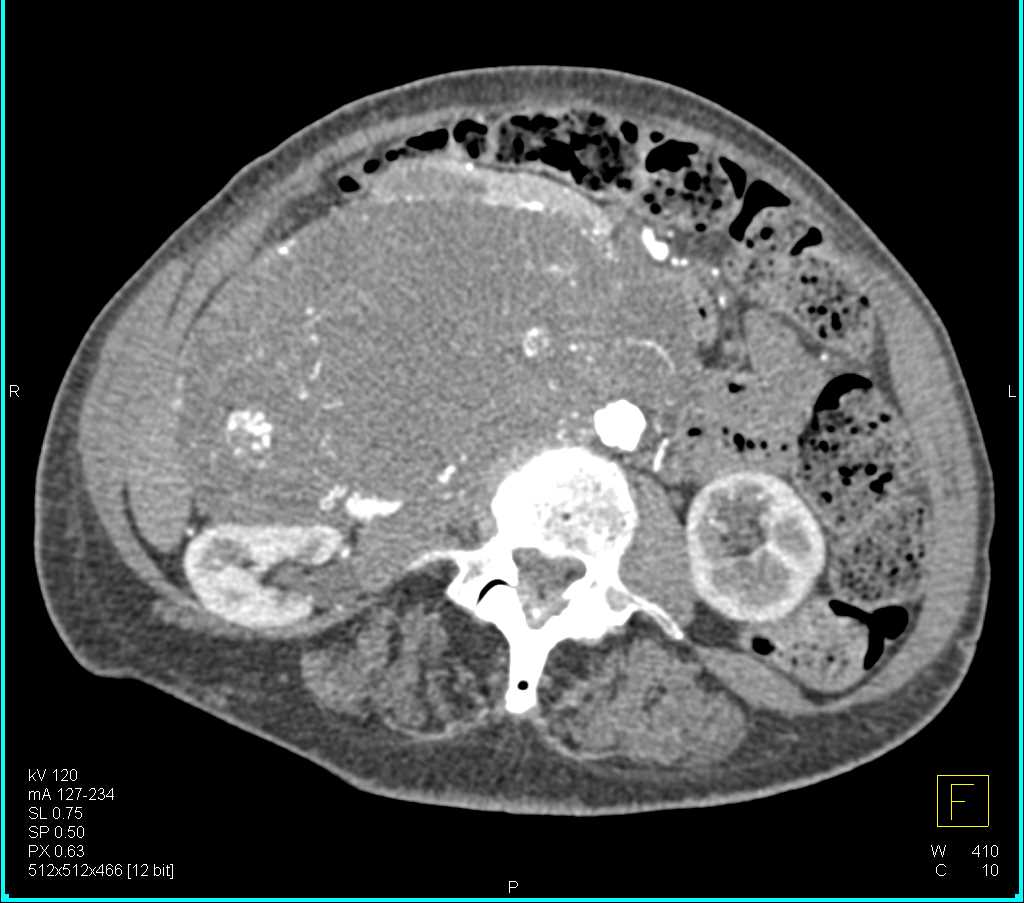 Hyervascular Retroperitoneal Sarcoma - CTisus CT Scan