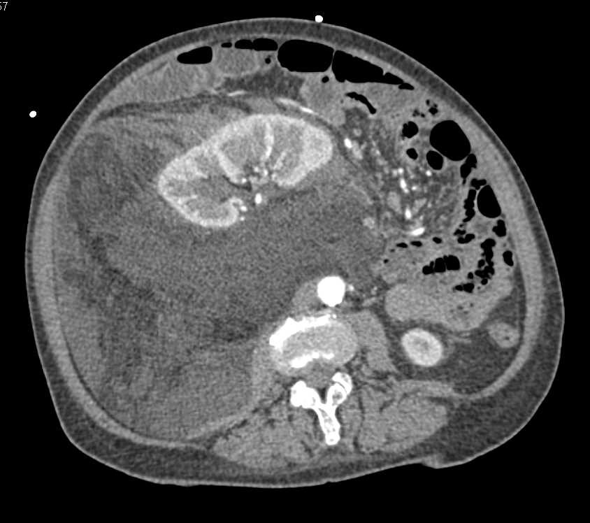 Retroperitoneal Liposarcoma - CTisus CT Scan