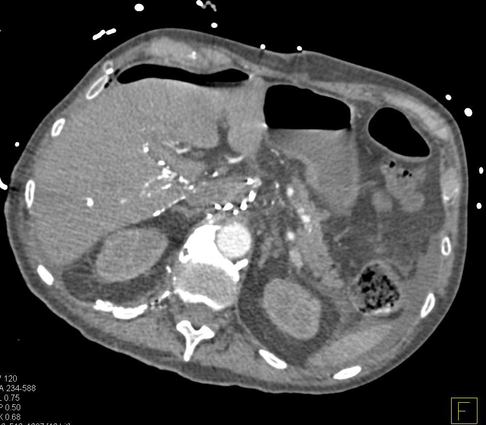 CT Post Lymphangiogram - CTisus CT Scan