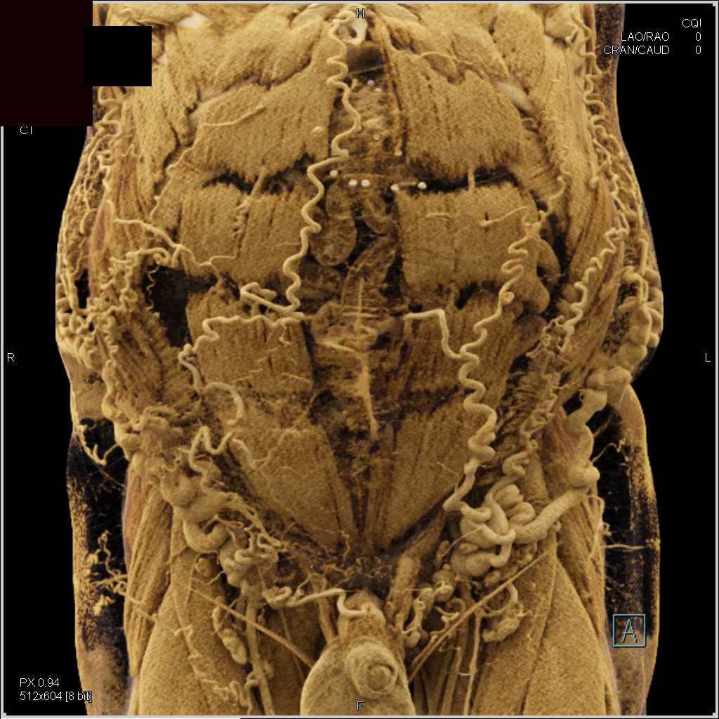 Prominent Collaterals in the Abdominal Wall - CTisus CT Scan