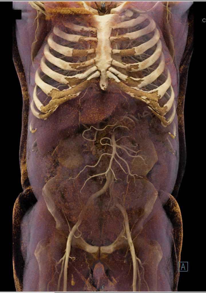 Abdominal Wall and Mesenteric Vessels - CTisus CT Scan