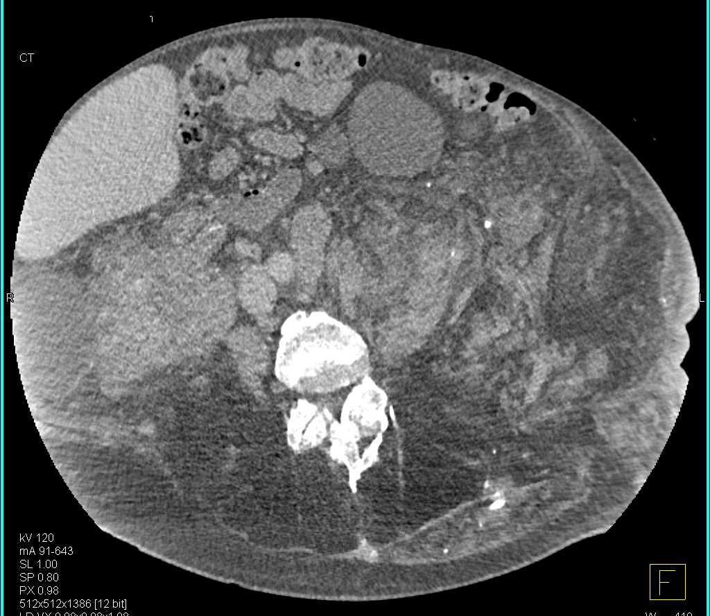Lymphangiomatosis Retroperitoneum - CTisus CT Scan