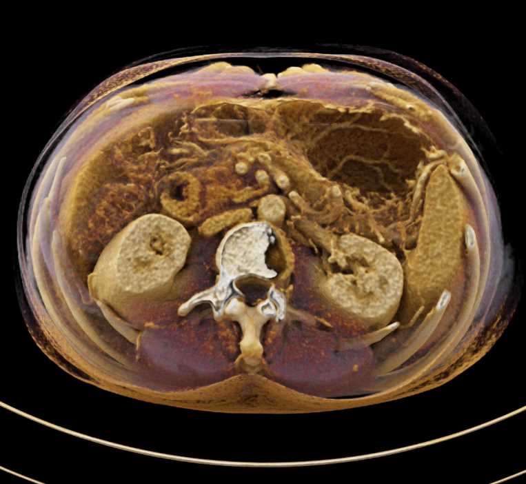 Duodenal Carcinoma with Cinematic Rendering - CTisus CT Scan