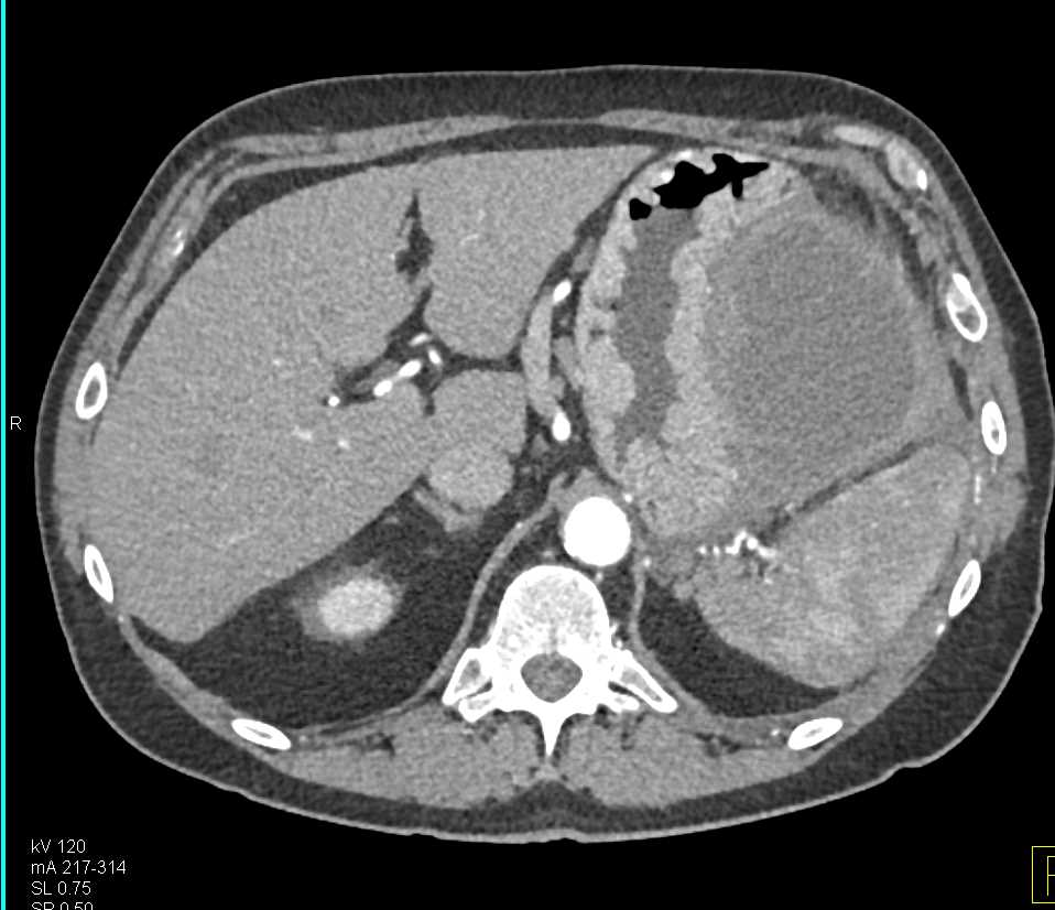 Left Upper Quadrant Abscess Near the Spleen and Stomach - CTisus CT Scan