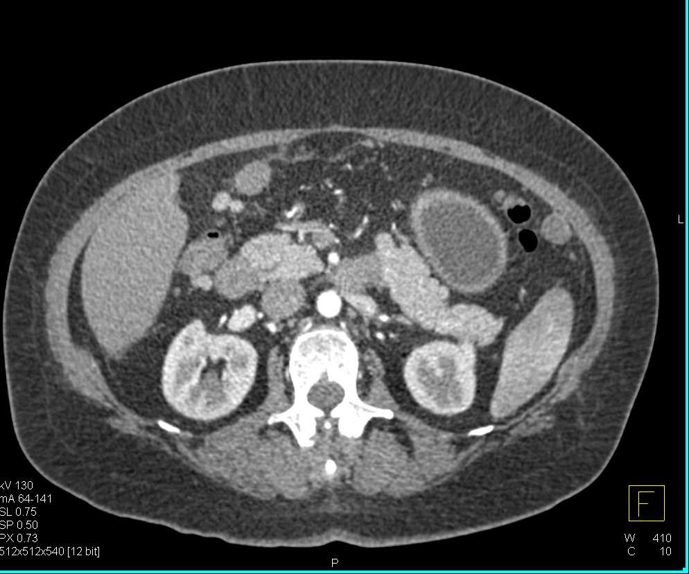Omental Implants - CTisus CT Scan