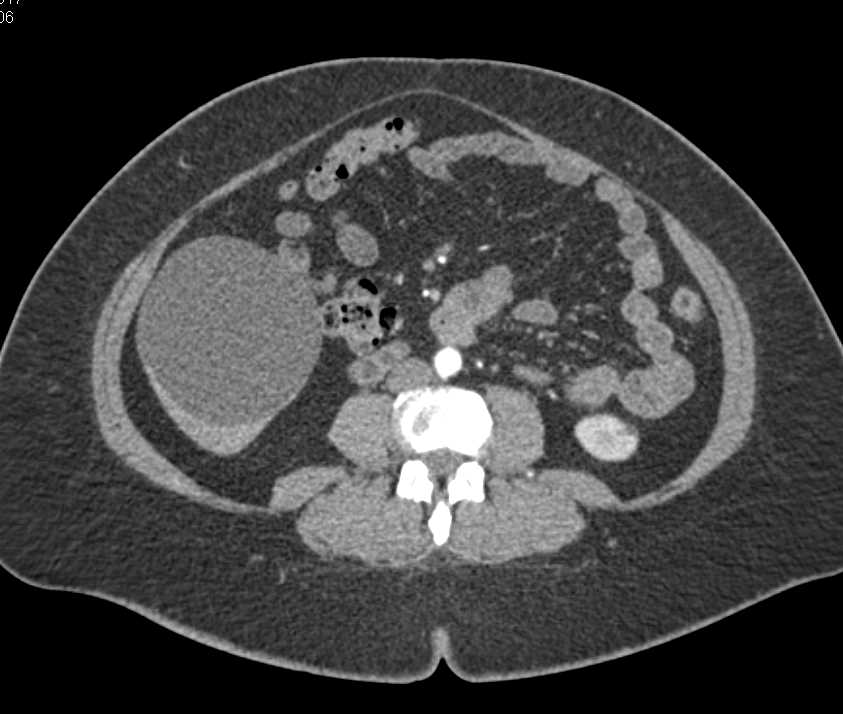 Mesenteric Cyst - CTisus CT Scan