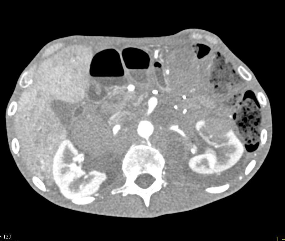 Metastatic Melanoma - CTisus CT Scan
