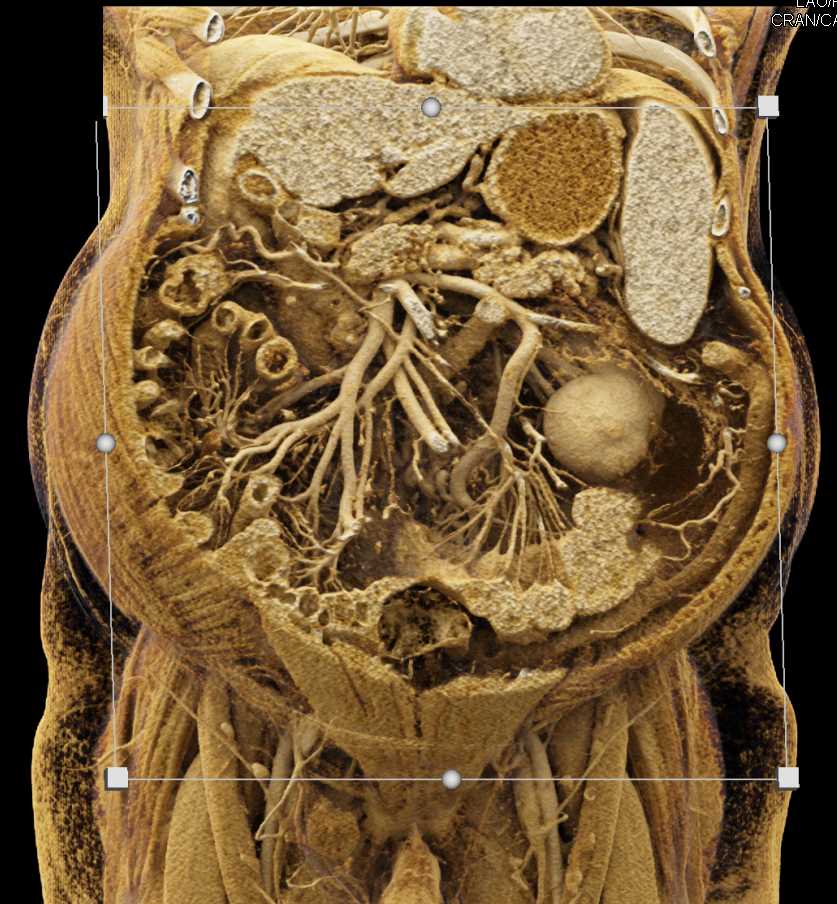 Prominent Mesenteric Arcade - CTisus CT Scan