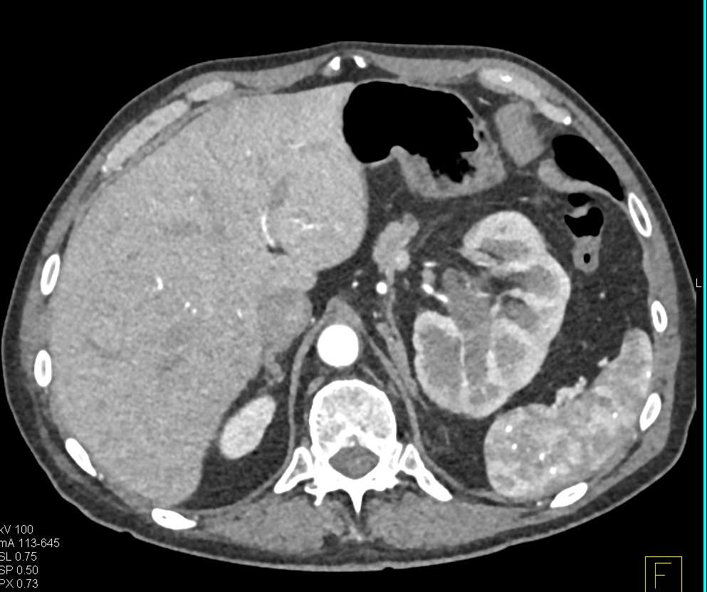 Retroperitoneal Sarcoma Displaces the Left Kidney - CTisus CT Scan