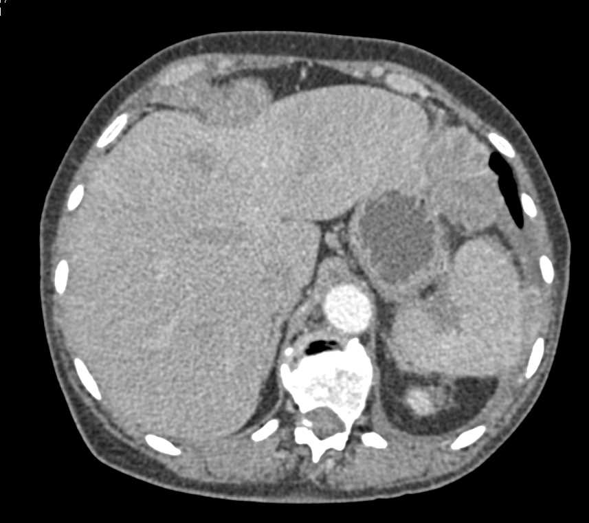 Carcinomatosis of the Abdomen with Multiple Implants - CTisus CT Scan