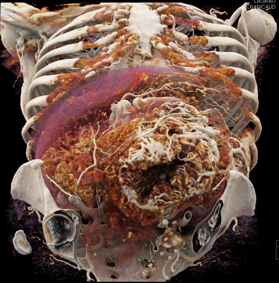 Large GIST Tumor with Neovascularity - CTisus CT Scan