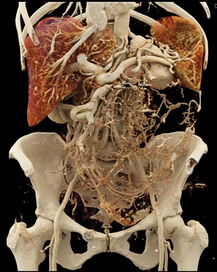 Large GIST Tumor with Neovascularity - CTisus CT Scan