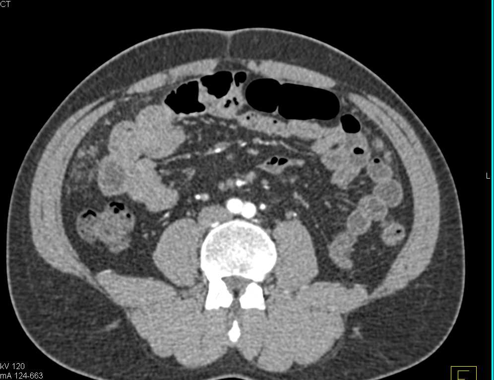 Omental Carcinomatosis - CTisus CT Scan