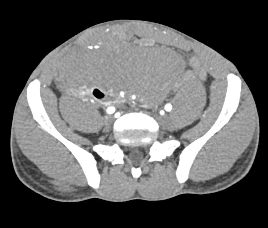 Desmoid Tumor - CTisus CT Scan