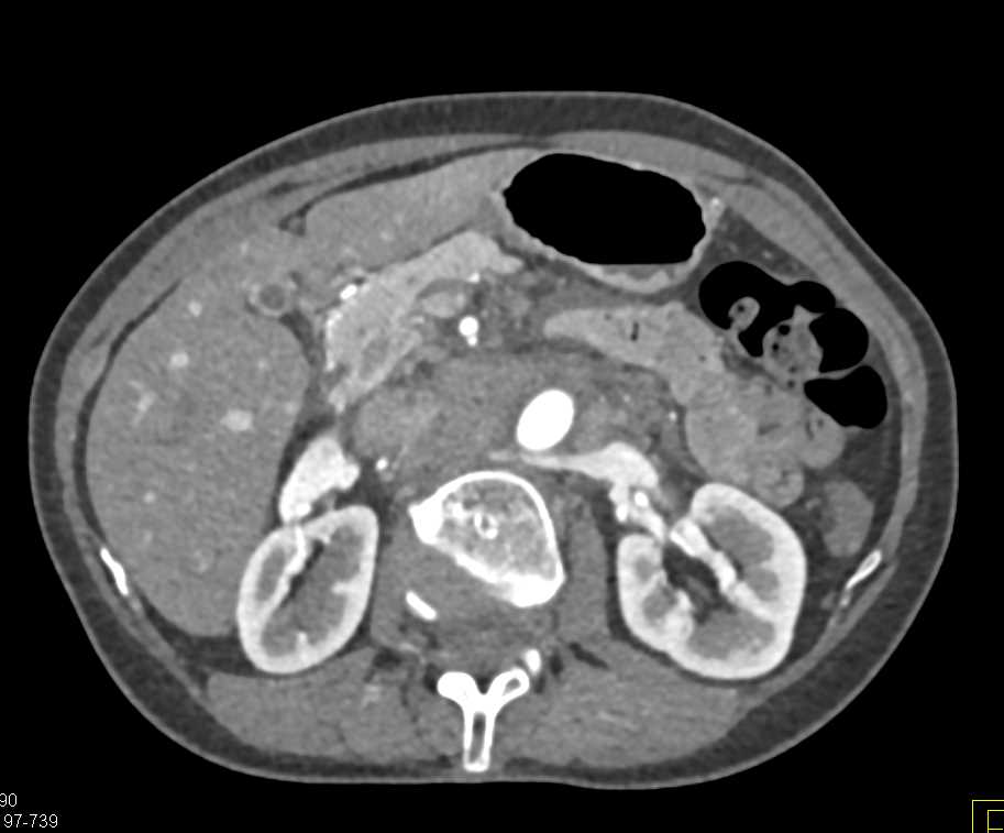 Lymphoma with Bulky Para-Aortic Adenopathy - CTisus CT Scan