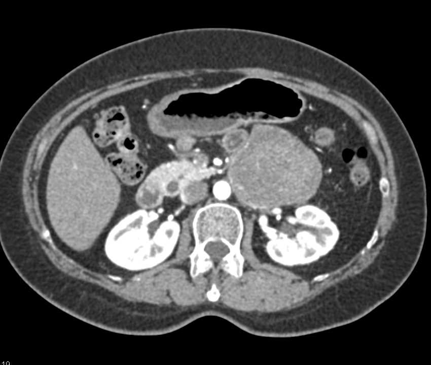 Retroperitoneal Liposarcoma - CTisus CT Scan