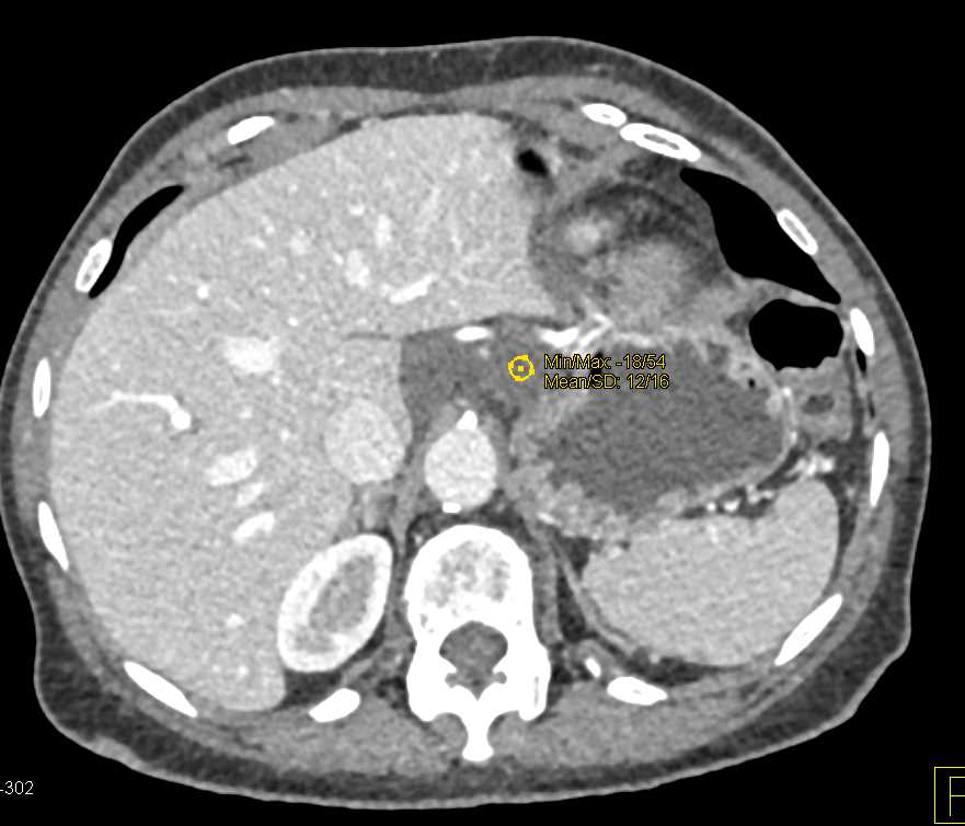 Lymphangioma - CTisus CT Scan