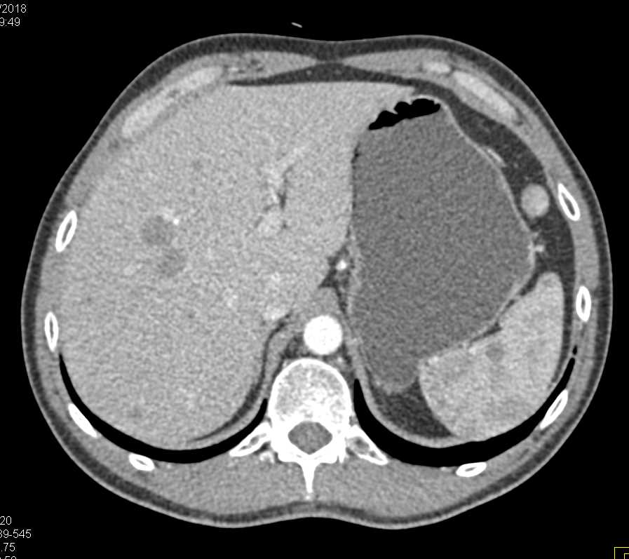 B-Cell Lymphoma - CTisus CT Scan