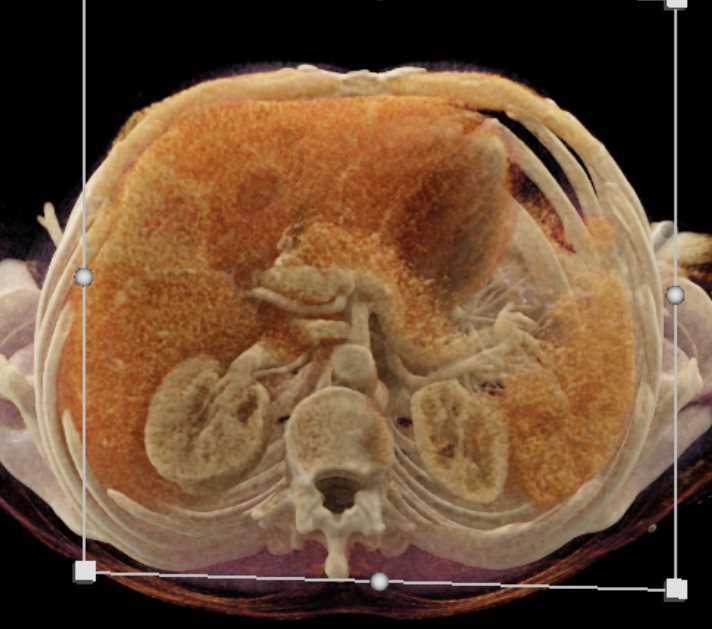 B-Cell Lymphoma - CTisus CT Scan