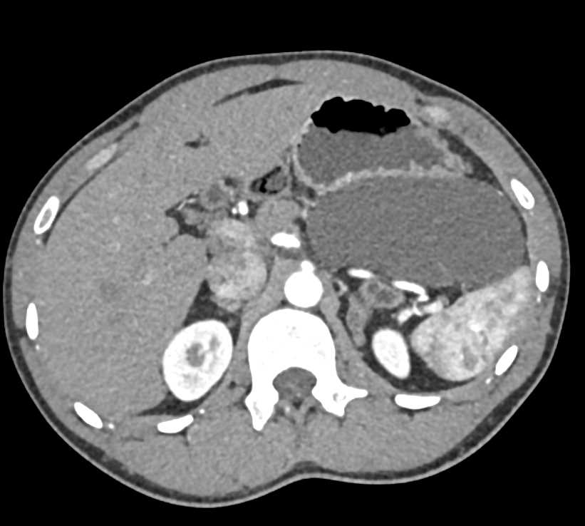 Cystic Lymphangioma - CTisus CT Scan
