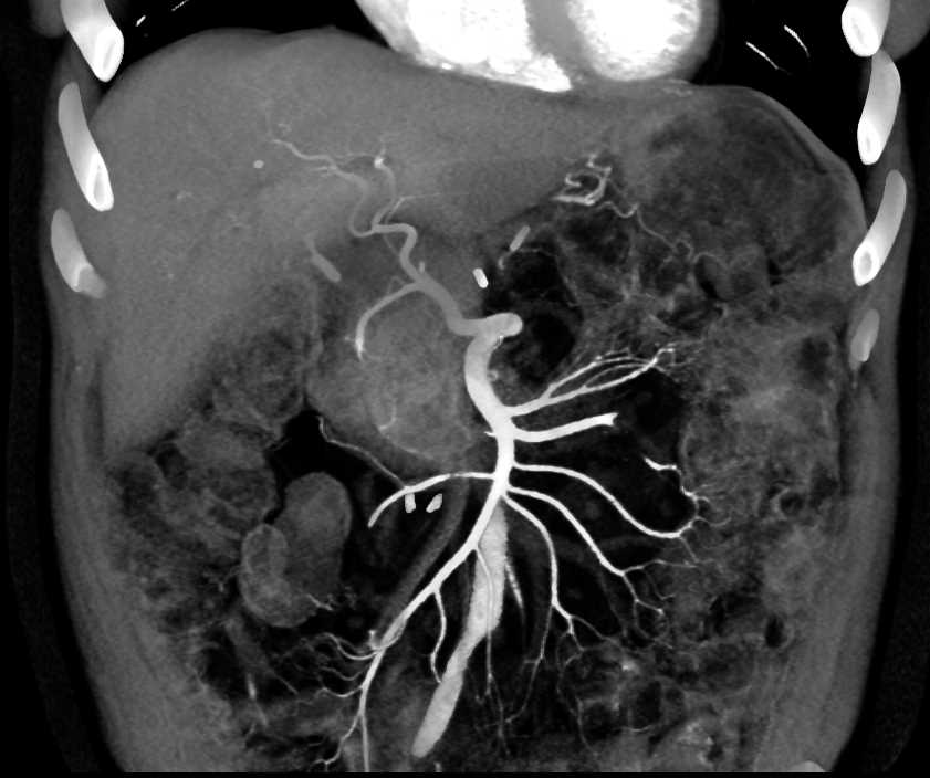 Gallbladder Cancer - CTisus CT Scan