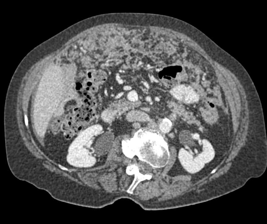 Carcinomatosis Involves the Omentum - CTisus CT Scan