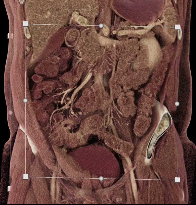 Crohn's Disease with Enetero-Enteric Fistulae - CTisus CT Scan
